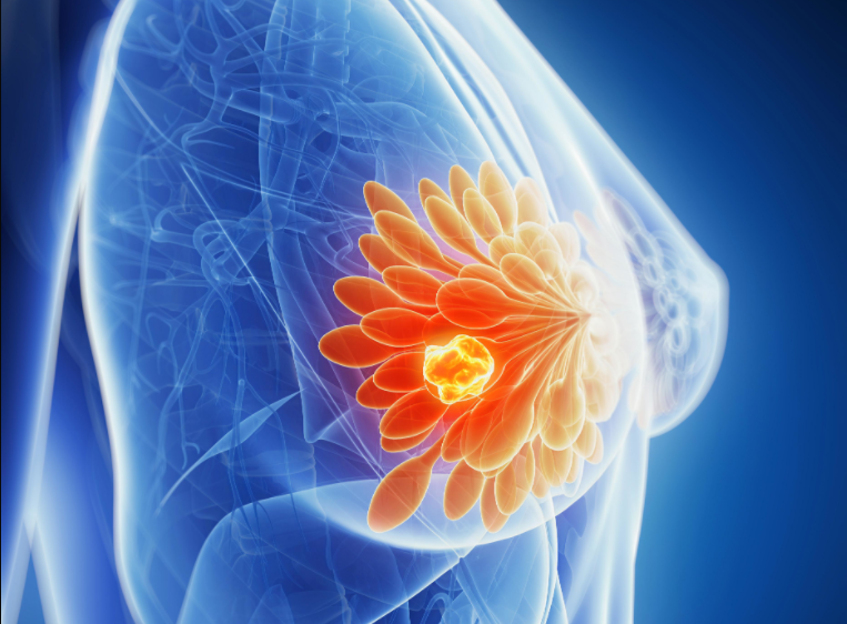 Breast Cancer, Radiotherapy